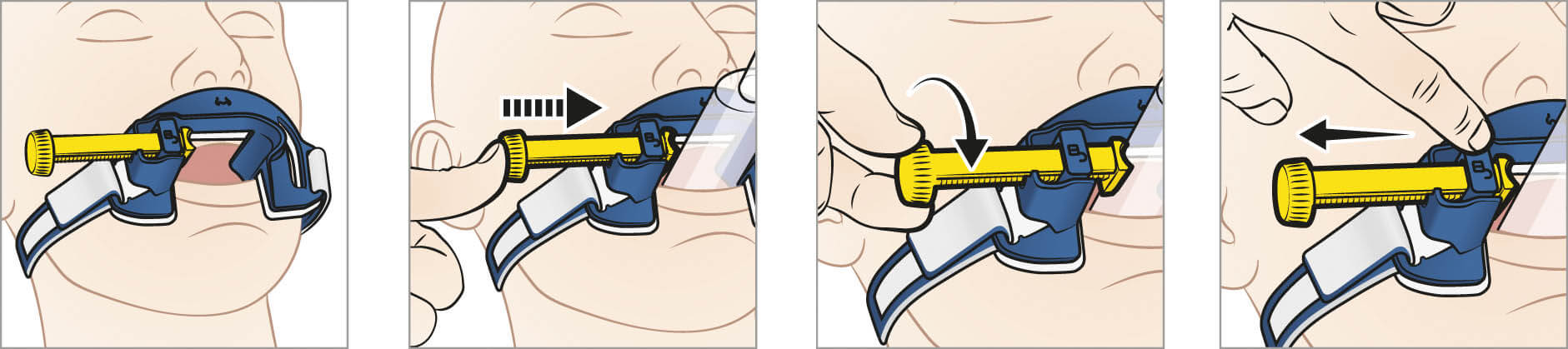 Thomas Select Endotrachealtubenhalter